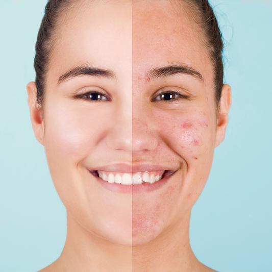 Trattamento Acne - i Fondamentali
